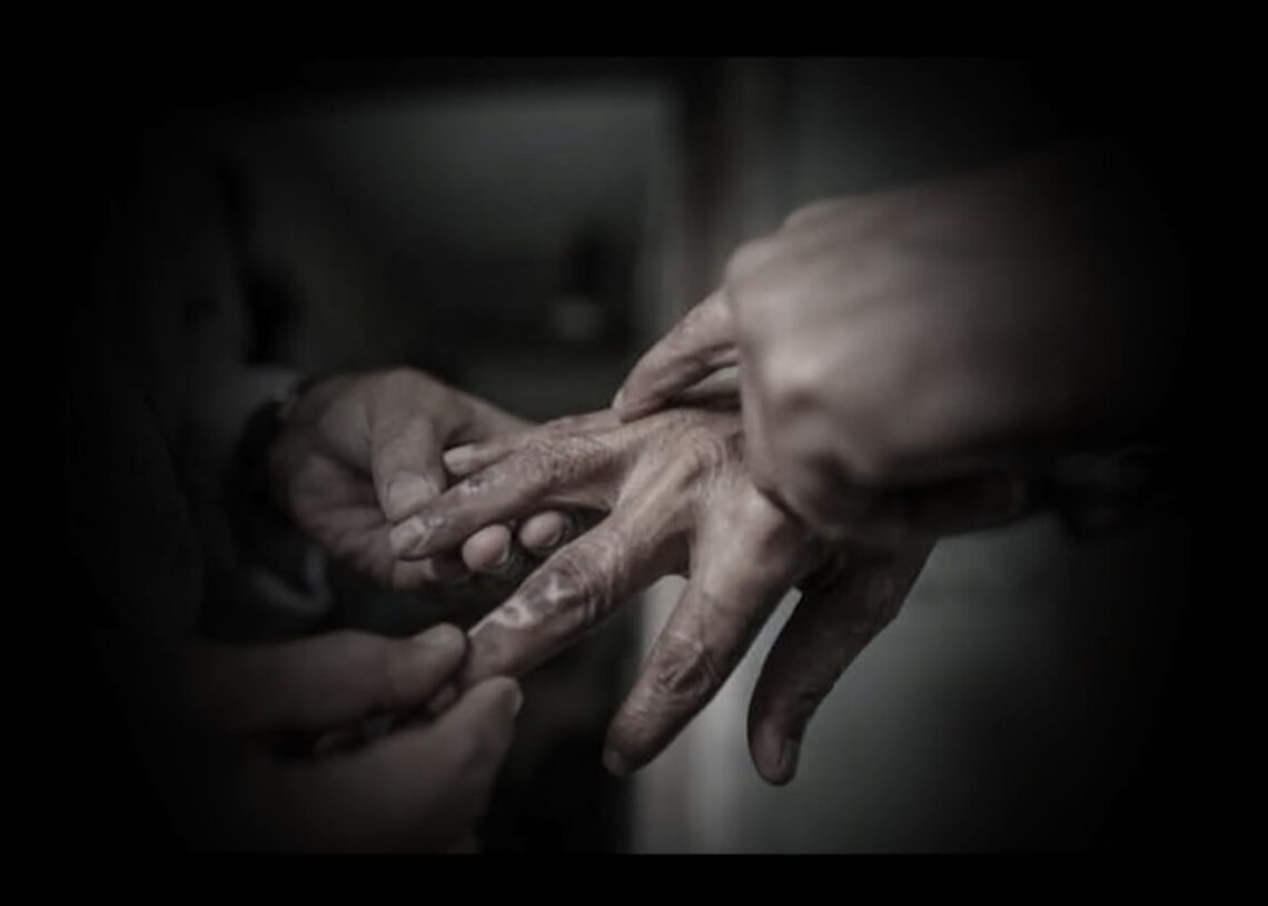 बाँकेमा १४६ जना नयाँ कुष्ठरोगी फेला